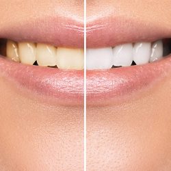 teeth care wantirna dentist tooth restoration