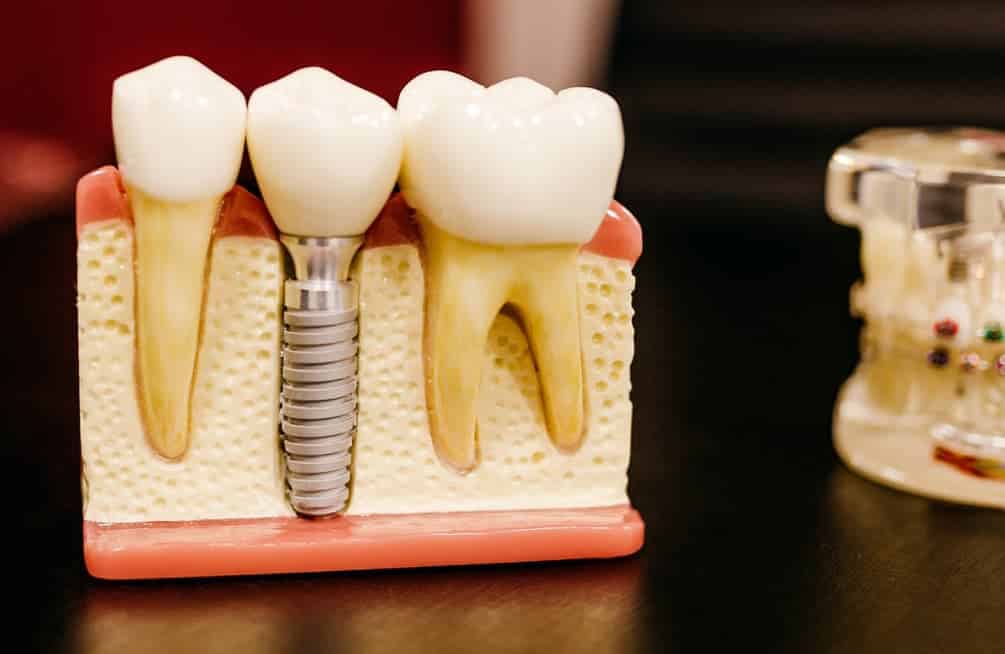 The importance of crown to root and crown to implant ratios